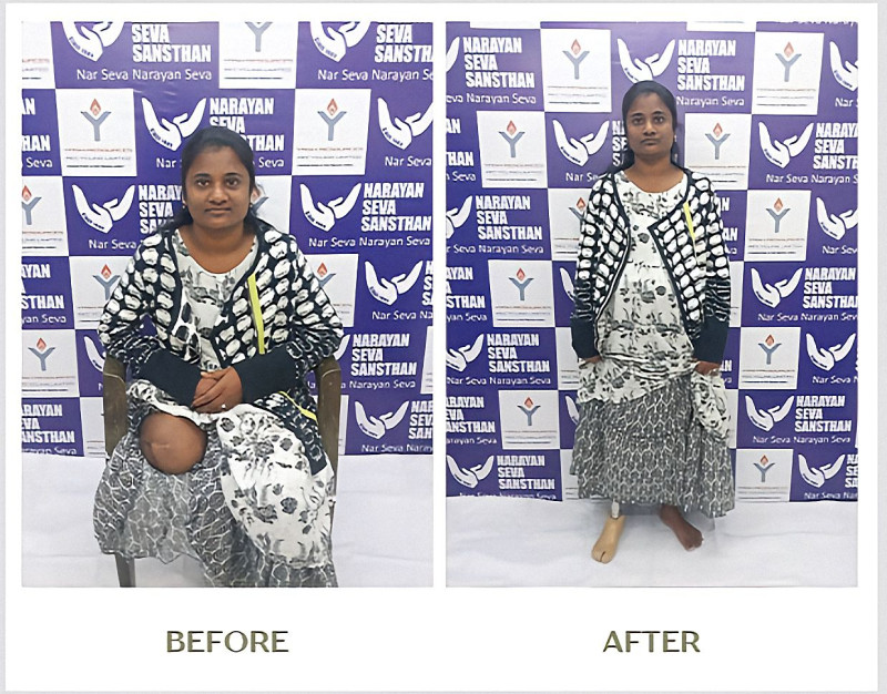 Narayan Seva Sansthan and Yash Resources Recycling Limited, Hyderabad Restore Mobility to 100 Persons with Disabilities through CSR Initiative decoding=