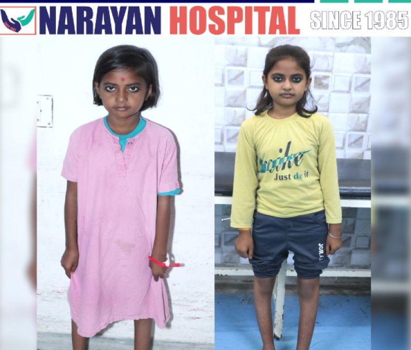 from-wheelchair-to-walking-polio-stricken-girl-gets-new-lease-on-life