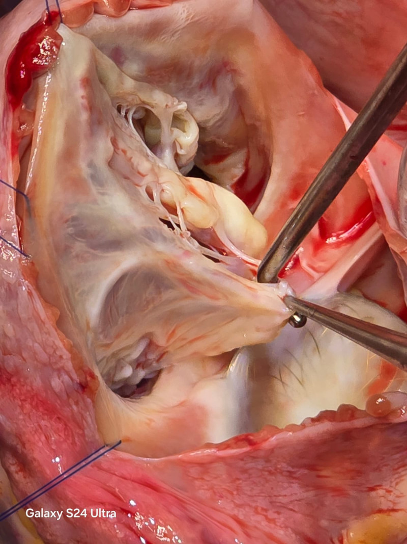 born-with-a-rare-heart-defect-treated-with-a-life-saving-modern-surgery-at-bm-birla-heart-hospital