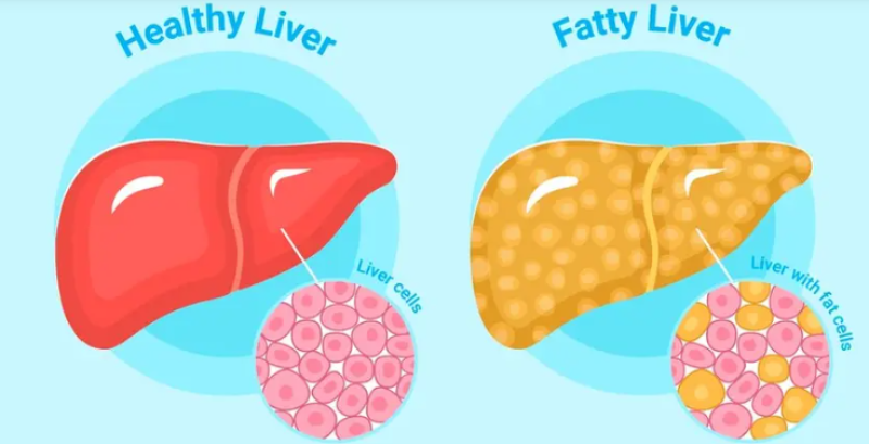 50-young-corporate-professionals-at-rising-risk-of-pre-diabetes-high-cholesterol-hypertension-heart-disease-and-fatty-liver