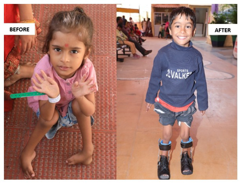 First Steps of Hope: Six-Year-Old from Bihar Walks After Successful Treatment for Clubfoot decoding=