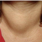 thyroid-nodule-vs-neck-lump-when-should-you-be-concerned