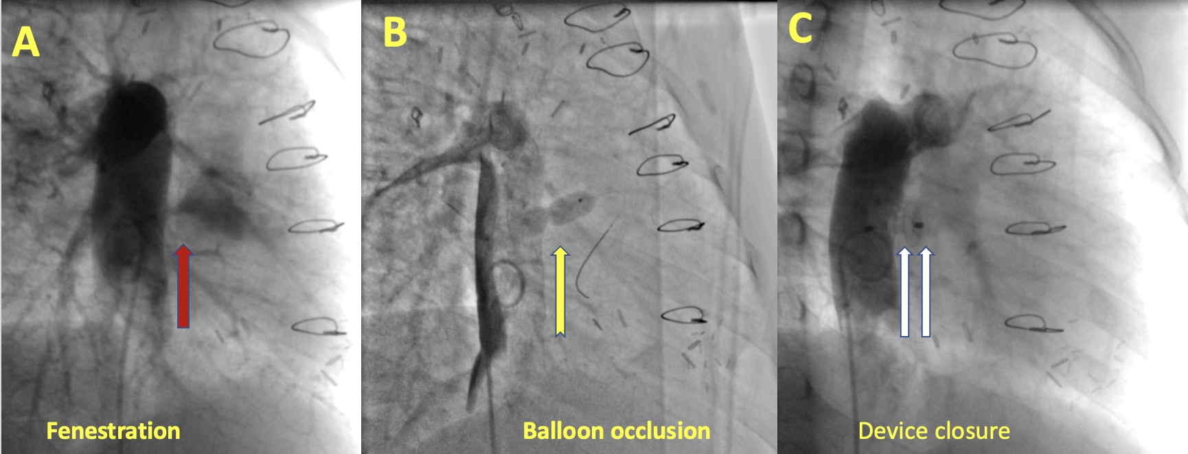 orphaned-by-covid-19-medica-treats-successfully-11-year-old-girl-by-unique-innovative-rotational-angiogram