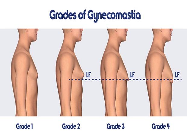 Male breast reduction (gynecomastia correction) can be done via Keyhole surgery decoding=