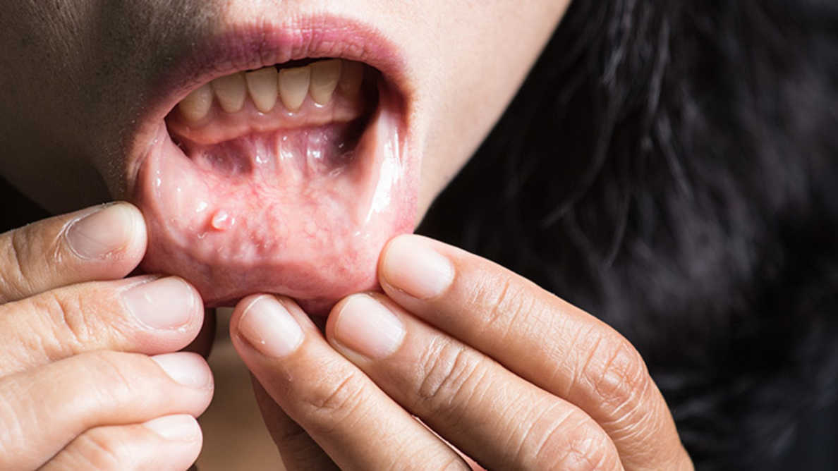 new-study-may-help-develop-therapeutics-for-tongue-cancer