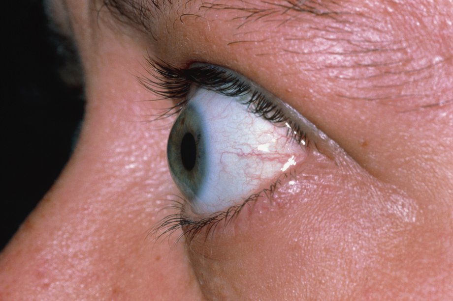 bulging-eyes-could-be-a-sign-of-serious-medical-condition-not-beauty