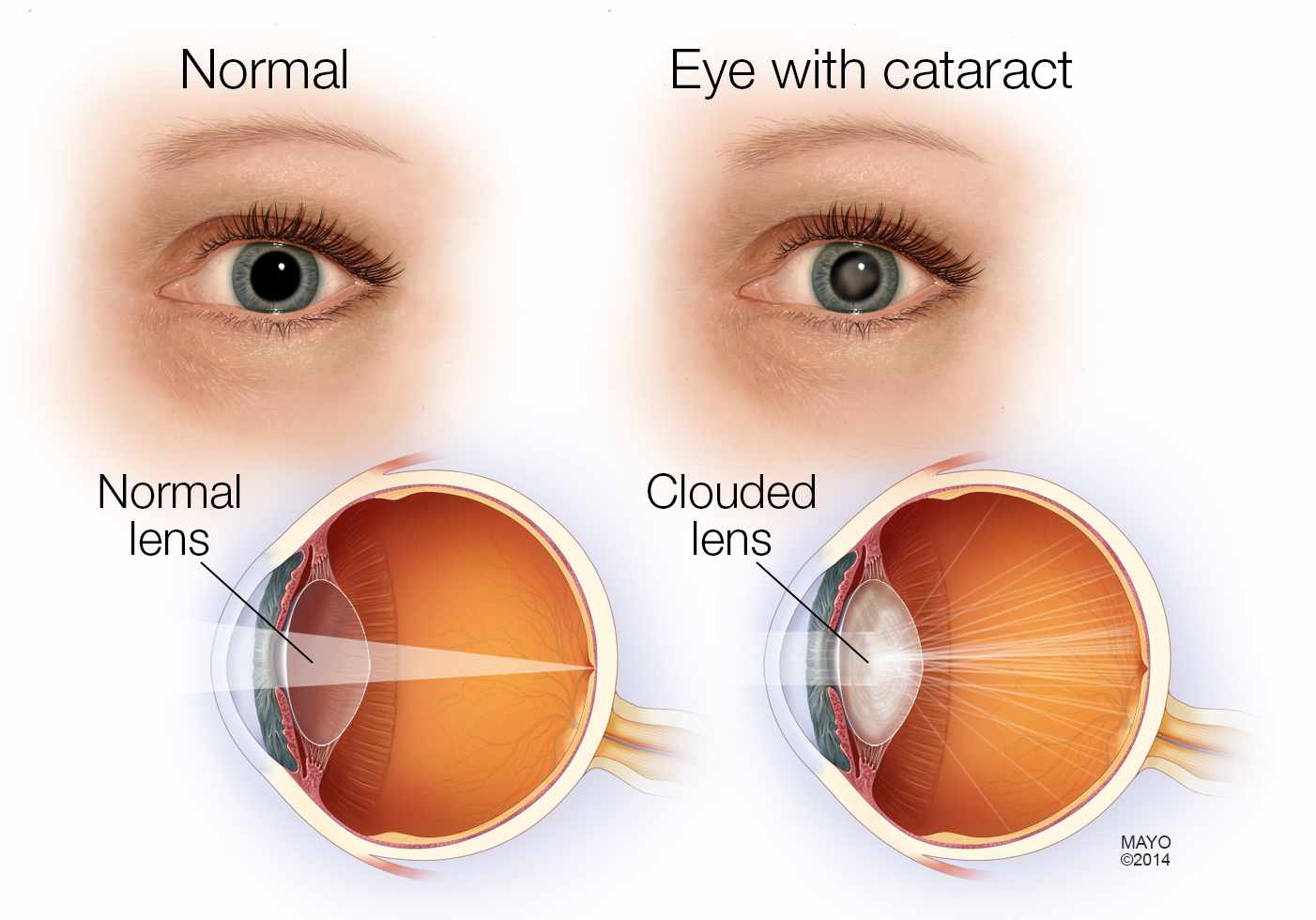 babies-can-have-cataracts-too-ensure-regular-eye-check-up-from-birth-itself