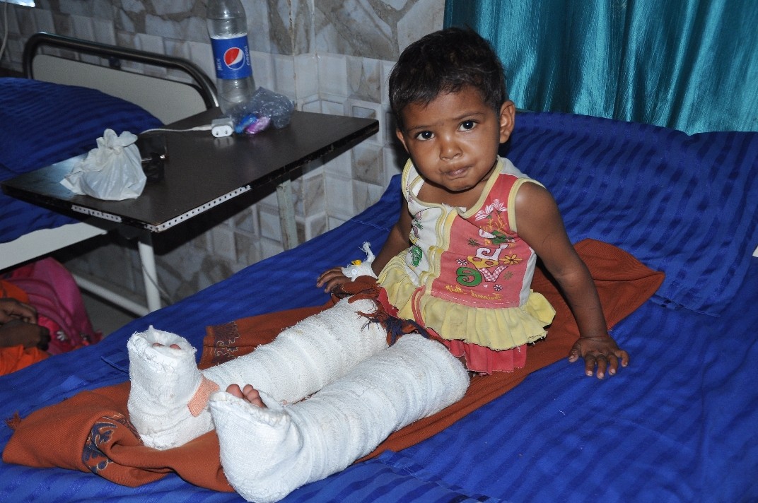 2-year-baby-survives-congenital-pseudoarthrosis-surgery