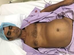 manipal-hospitals-successfully-removes-9-kg-tumor-to-give-new-lease-of-life-to-41-year-old-patient