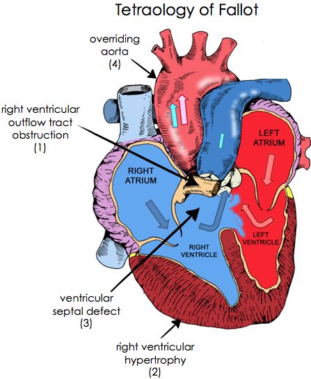 genetic-or-environmental-factors-can-cause-a-hole-in-your-childs-heart-at-birth