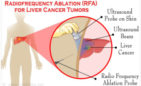 nanomedicine-for-liver-cancer-developed-by-amrita-researchers-gets-us-australia-patent