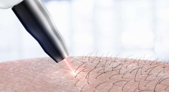 why-do-you-need-best-laser-hair-removal-now
