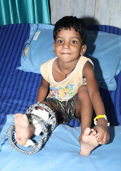 forming-a-life-beyond-deformity-overcoming-the-hurdle-of-being-differently-abled-with-nss-as-the-saviour-international-disability-day