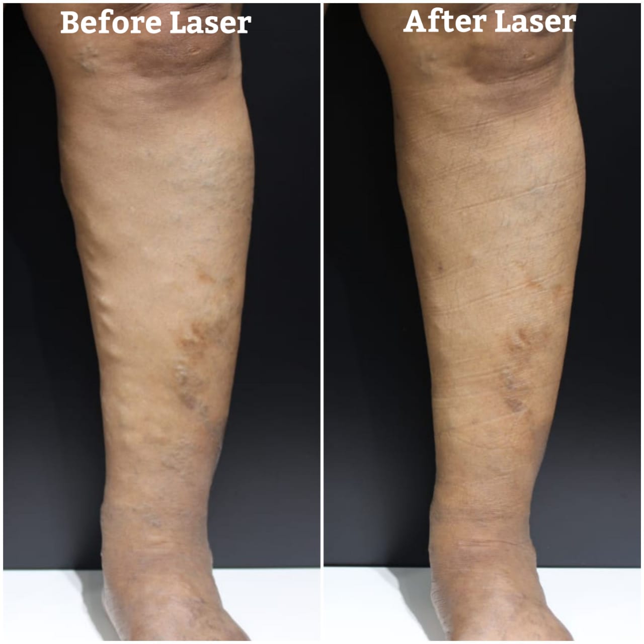 dombivli-mans-33-yearlong-battle-against-varicose-veins-ends-at-the-age-of-53