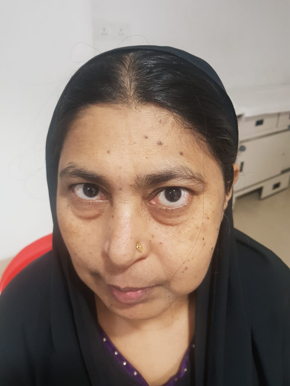 55-year-old-woman-with-rare-maxillary-nerve-schwannoma-treated