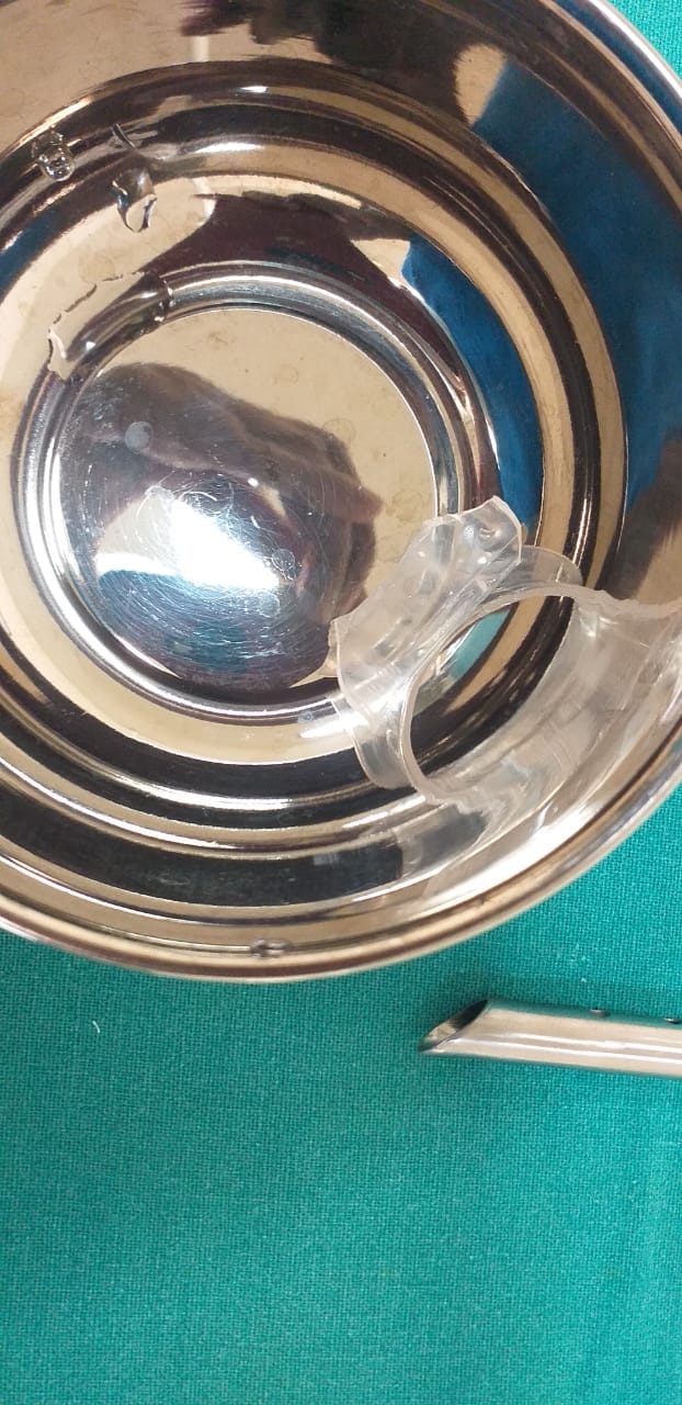 doctors-from-wockhardt-hospital-remove-15-inch-bottle-cap-stuck-in-an-infant8217s-throat