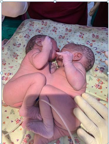 conjoined-twins-return-home-in-the-new-year-after-successful-separation-at-wadia-hospital