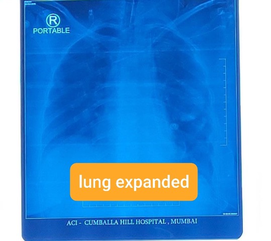 aci-cumballa-hill-hospital-performed-a-rare-and-complex-surgery-successfully