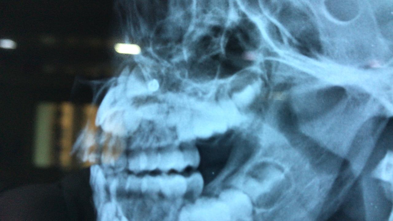 wockhardt-hospital-successfully-pulled-out-foreign-bodies-lodged-in-children-during-the-lockdown